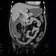 Tumor of cecum, enterography: CT - Computed tomography